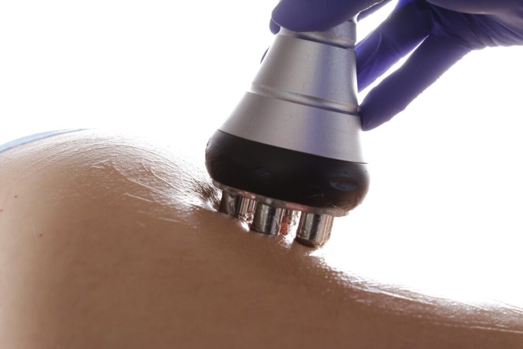 Traitement cellulite radiofréquence