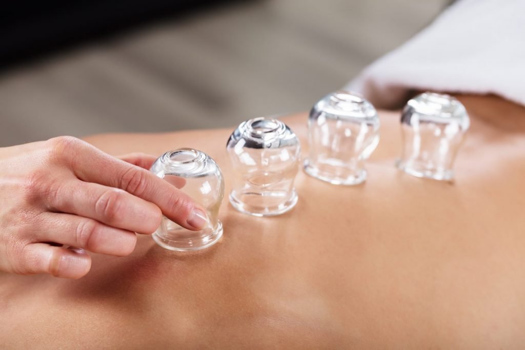 Co je cupping?