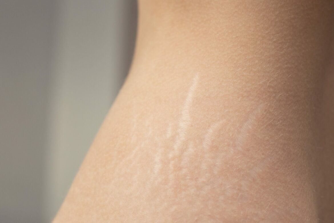 Se débarrasser rapidement naturellement vergetures