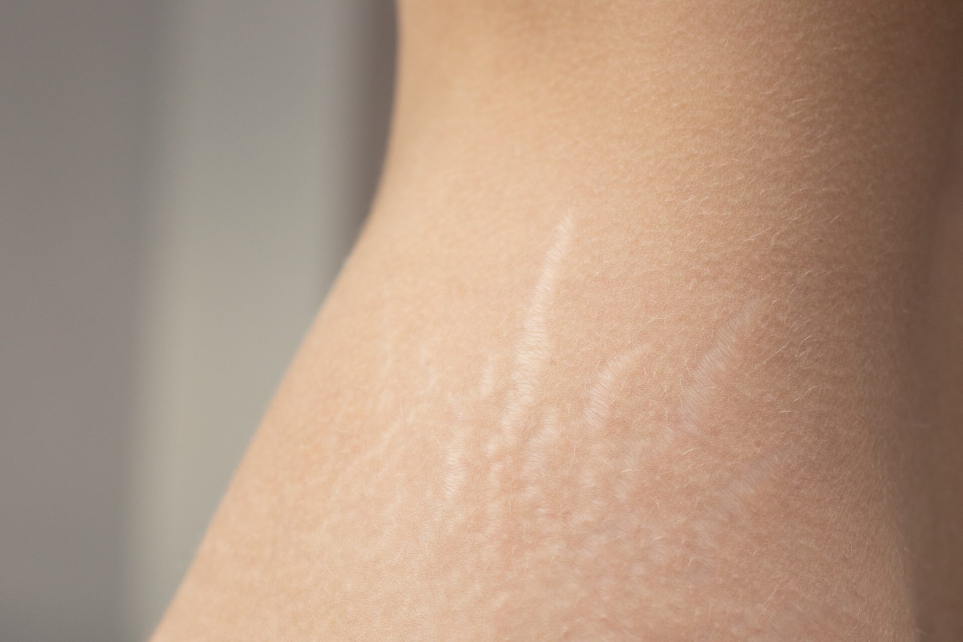 Se débarrasser rapidement naturellement vergetures