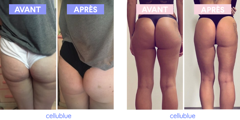 Avant après ventouse anti-cellulite fesses-cellublue