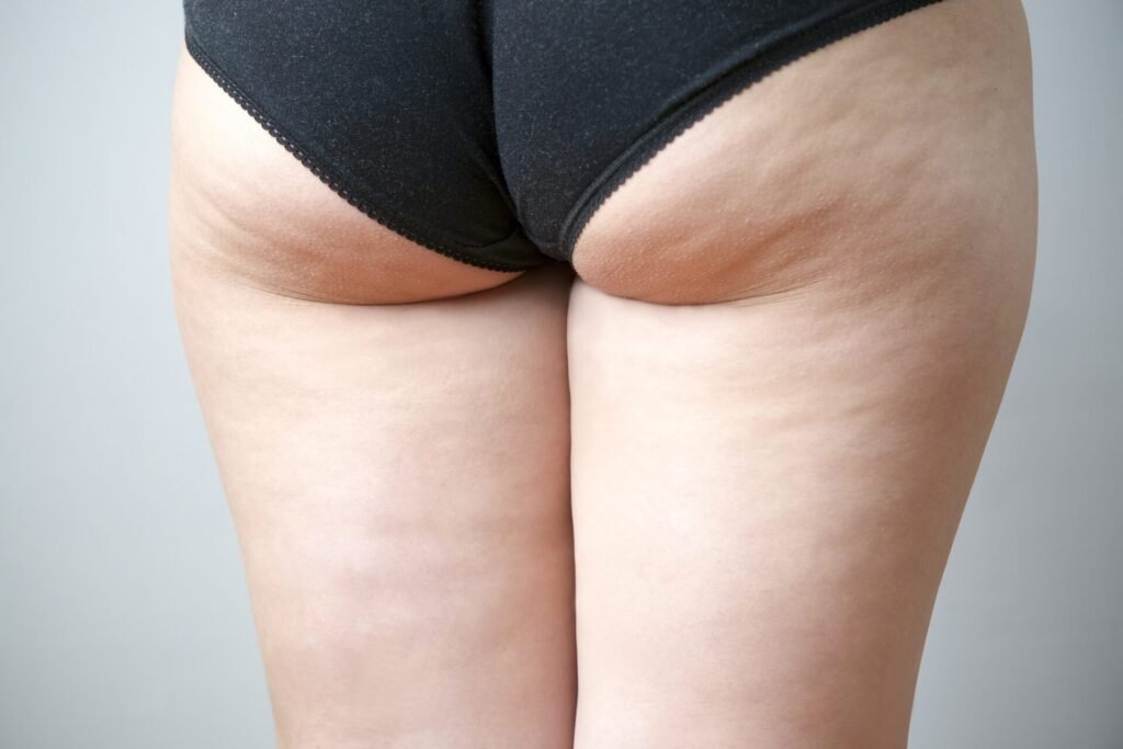 Bas de contention cellulite aqueuse