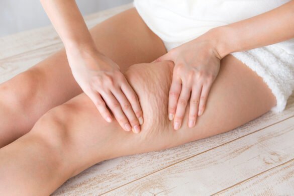 What is the difference between cellulite and orange peel skin?