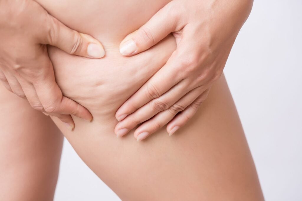 Perdre du poids permet-il de faire disparaître la cellulite ...