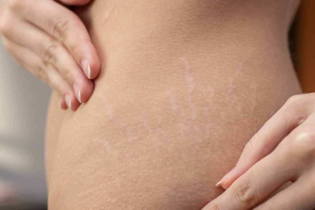 Huile tournesol peau vergetures