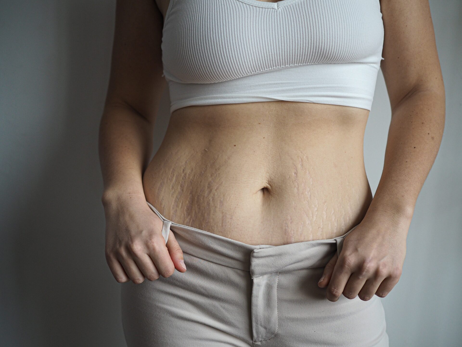 Enlever vergetures 3 jours