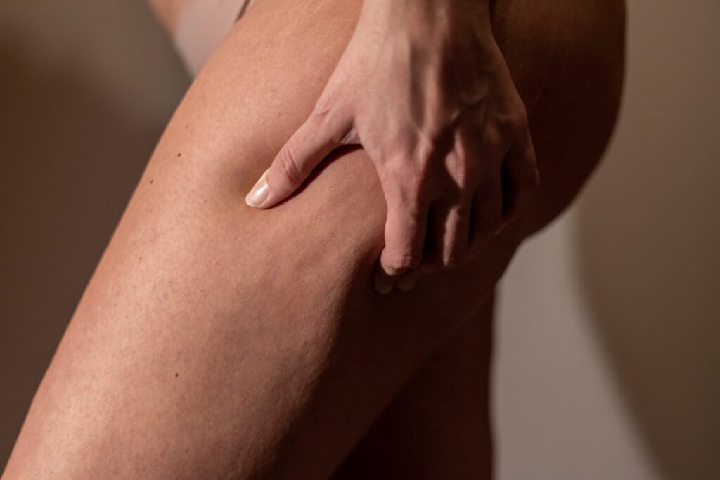 Gluten cellulite réalité