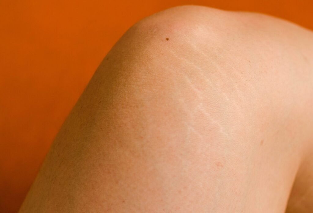 Stretch marks on the knees: how to reduce them?