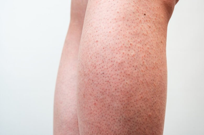 Comment se débarrasser de la peau de fraise ? - Peau de fraise
