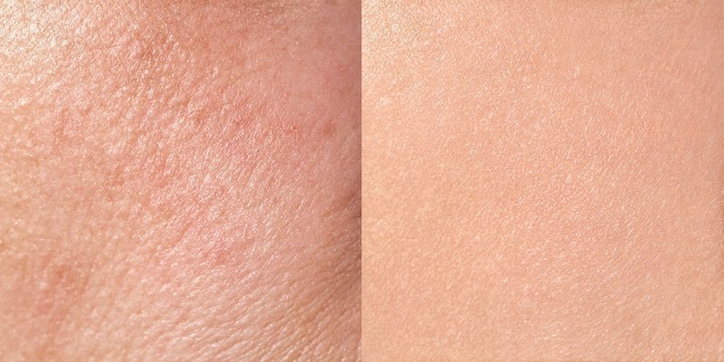 evolution du collagene