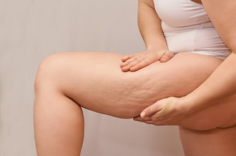 Cuisses flasque cellulite