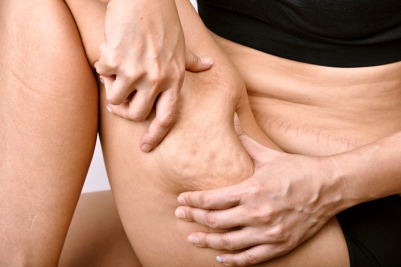pincement cellulite sur les cuisses