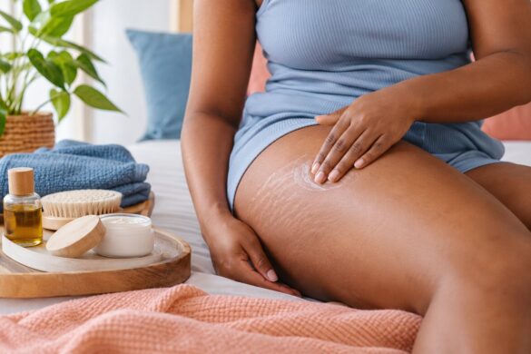 Estrias em peles negras ou mestiças: soluções