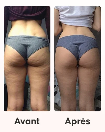 Cura Anti-Celulite