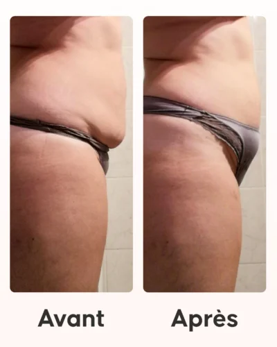 Programa Barriga Lisa